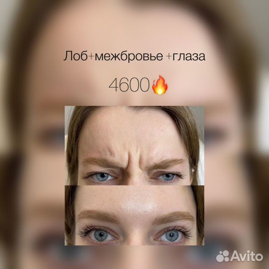 Ботокс для лица