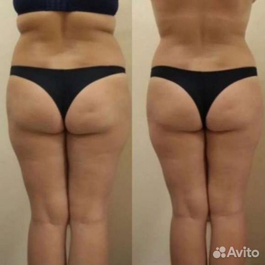 Аппаратный массаж/Ищу модель