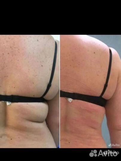 Криолиполиз Безопасное похудение Геленджик