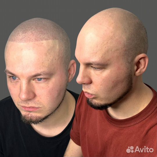 Мужская трихопигментация