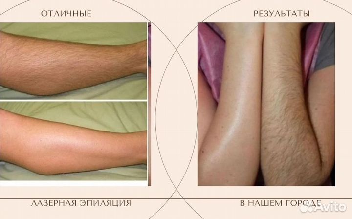 Лазерная эпиляция александритовая+диодная волна