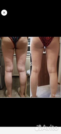 Антицеллюлитный массаж ручной