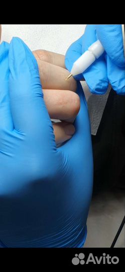 Электроэпиляция