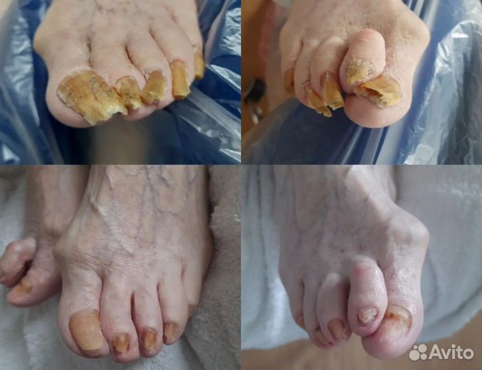 Подолог.Медицинский педикюр. Выезд на дом