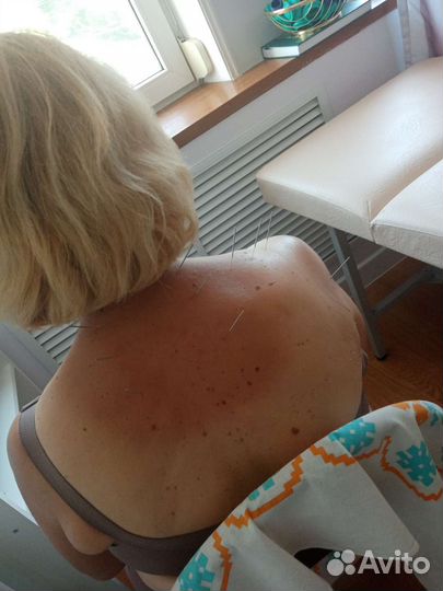 Похудение. Снижение веса микроиглами