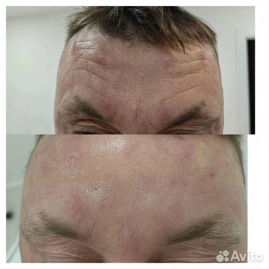 Ботулинотерапия. Лечение гипергидроза