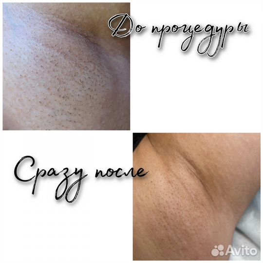 Электроэпиляция