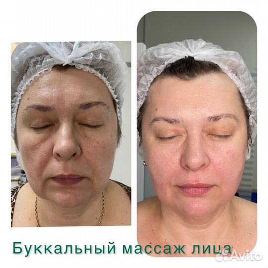 Скульптурно-буккальный массаж