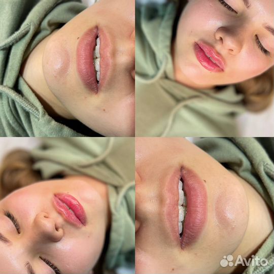 Аугментация губ
