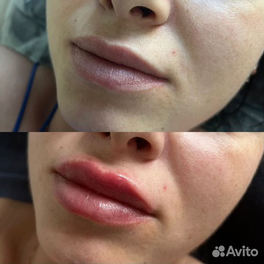 Смас лифтинг лица