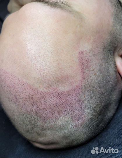 Трихопигментация кожи головы.Для мужчин и женщин