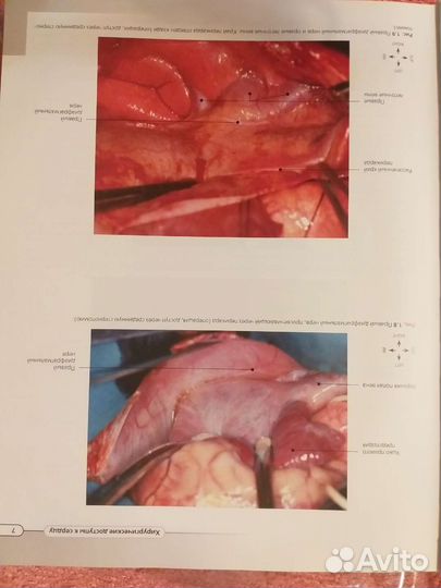 Хирургическая анатомия по Уилкоксу