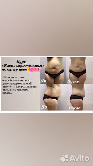 Аппаратный массаж