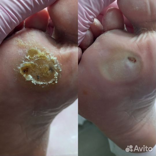 Подолог. Педикюр проблемной стопы