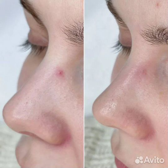 Удаление купероза, сосудистых звездочек, розацеа