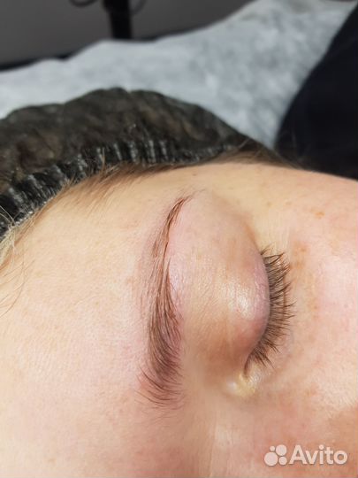 Удаление татуажа