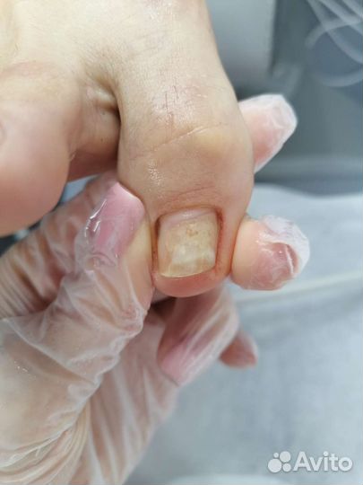 Медицинский педикюр подолог