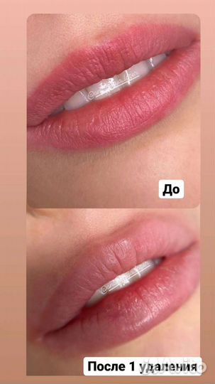 Удаление Тату/Татуажа лазером, карбоновый пилинг