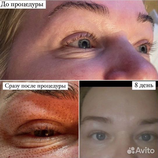 Безоперационная блефаропластика