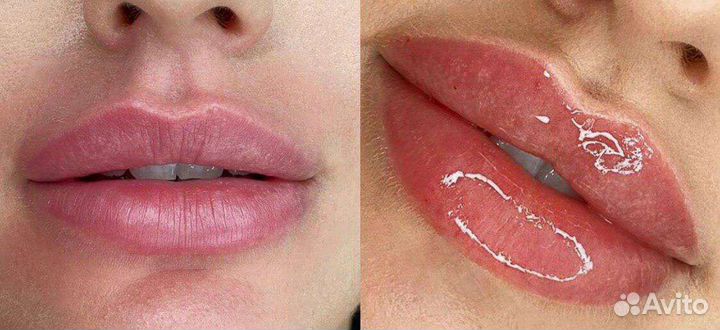 Увеличение губ, контурная пластика, хол.плазма