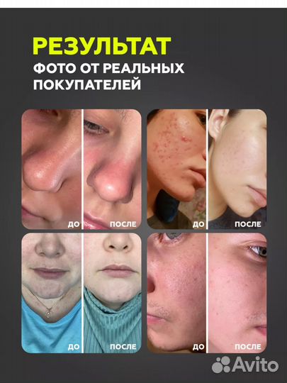УЗ чистка для лица