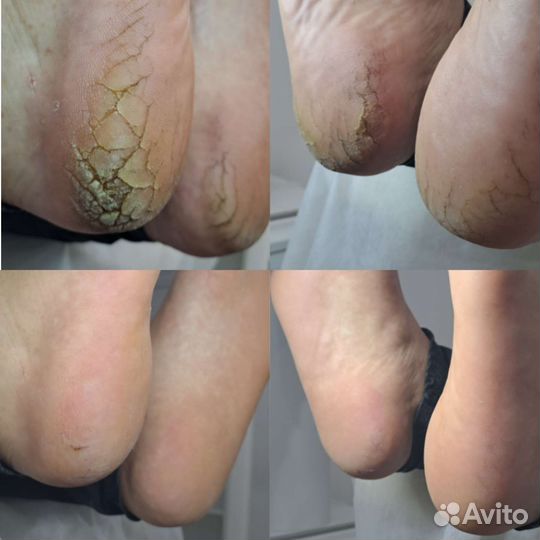 Smart педикюр с элементами подологии, маникюр