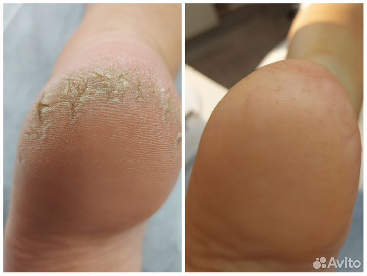 Педикюр(Smart)