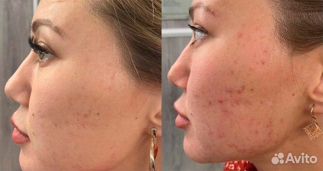 Холодная плазма лифтинг омоложение лица