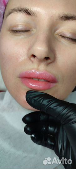 Увеличение губ