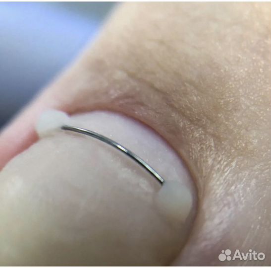 Установка титановой нити. Подолог