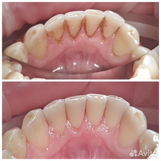 Сертификат на снятие зубных отложений