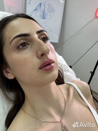 Аугментация губ