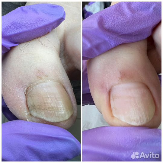 Лечебный педикюр