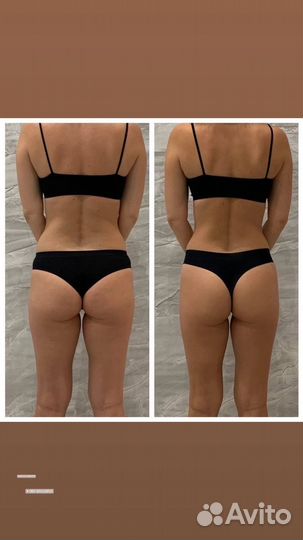 Аппаратный массаж тела