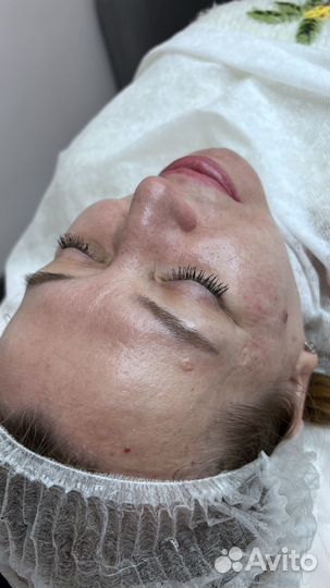 Чистка лица