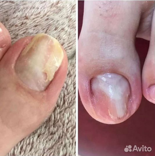 Подолог мозоли натоптыши грибки и др