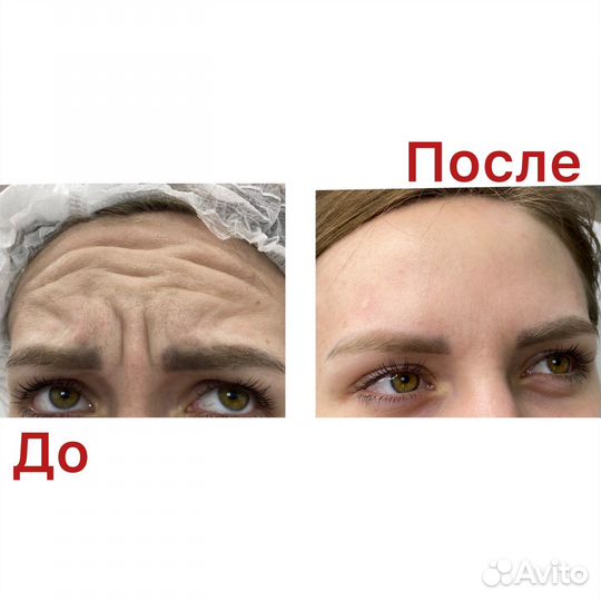 Ботокс для лица