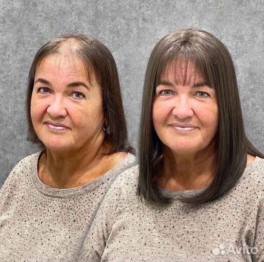 Система замещения волос