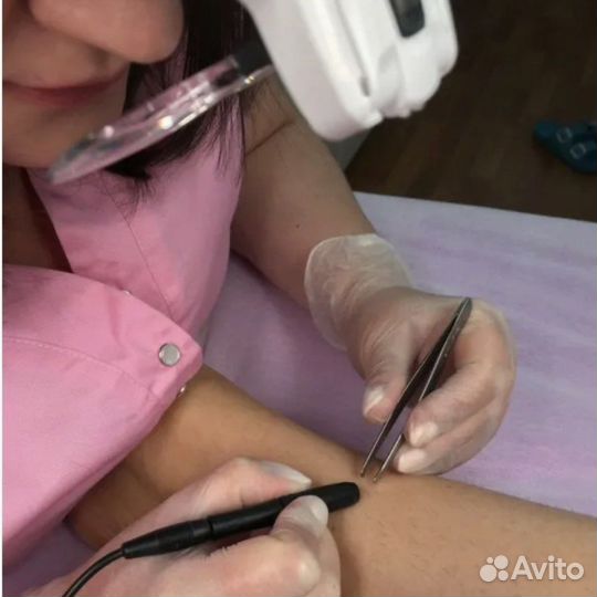 Электроэпиляция