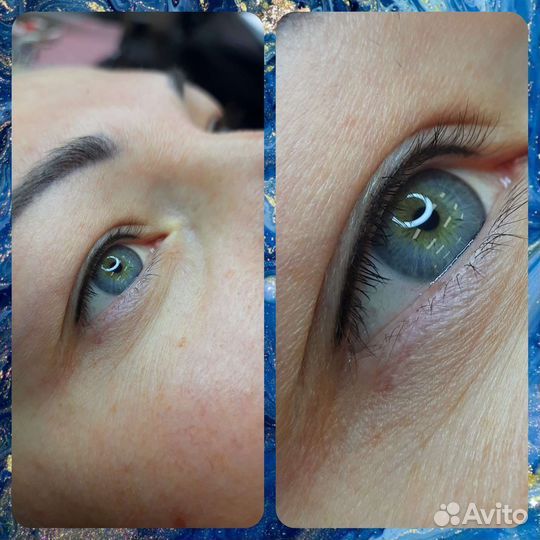 Татуаж бровей, губ, веки. Удаление татуажа