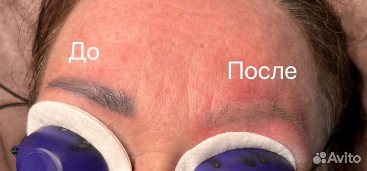 Удаление татуажа бровей лазером