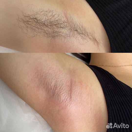 Шугаринг/ваксинг