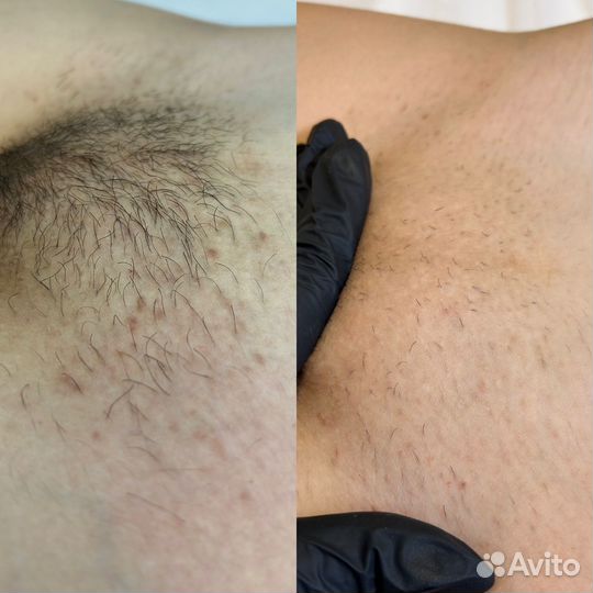 Электроэпиляция