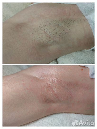 Электроэпиляция