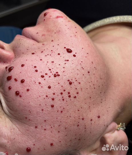 Капиляротерапия