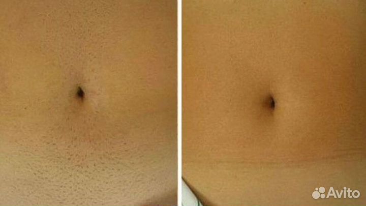 Лазерная эпиляция