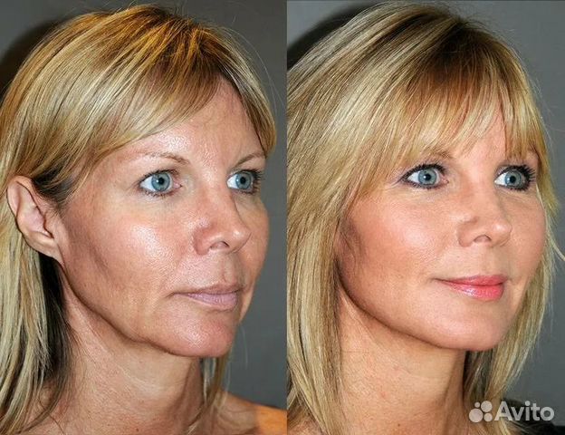Ботокс фул фейс в Москве | Услуги | Авито