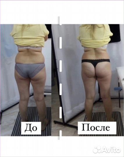 Аппаратная коррекция фигуры. Плoский живот