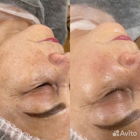 Гидропилинг