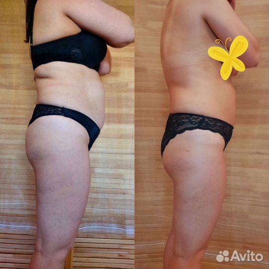 Массаж для похудения. Антицеллюлитный массаж.Налар